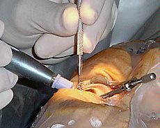 cataract surgery